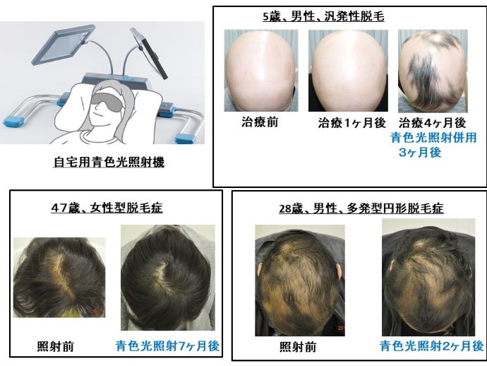 円形脱毛症　病院